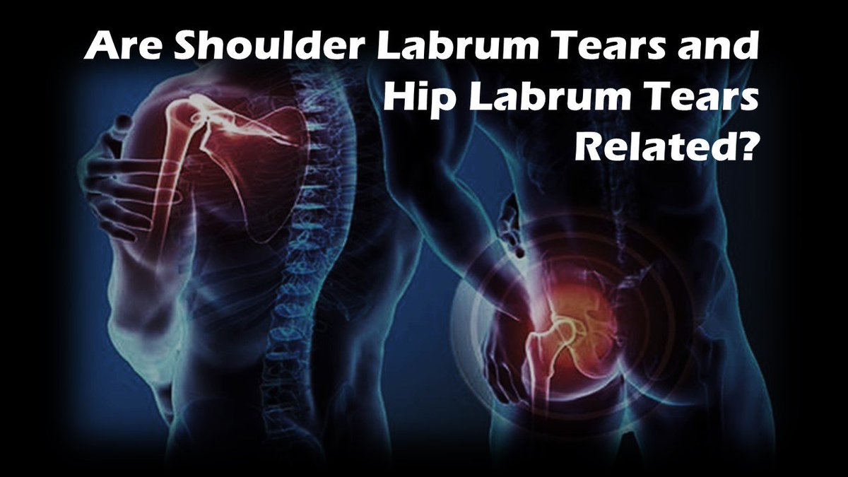 CCentenoMD's tweet photo. If You Have a Hip Labrum Tear, You May Also Have a Shoulder Labrum Tear? #regenexx #hiplabrum #shoulderlabrum https://t.co/j5fNzTuMVt https://t.co/Hc6NjudylA