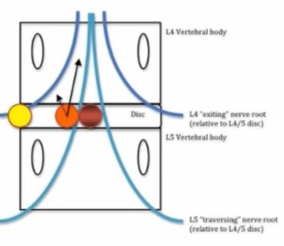 🆘¿Qué raíz comprime mi HERNIA DISCAL?
▪️Si tenemos una Hernia L4-L5 y es:
   🔸Lateral: Comprime L4 la del     mismo nivel.
   🔸Central: Comprime L5 , la que sale un nivel por debajo.
✅Imagen muy ilustrativa para entenderlo.