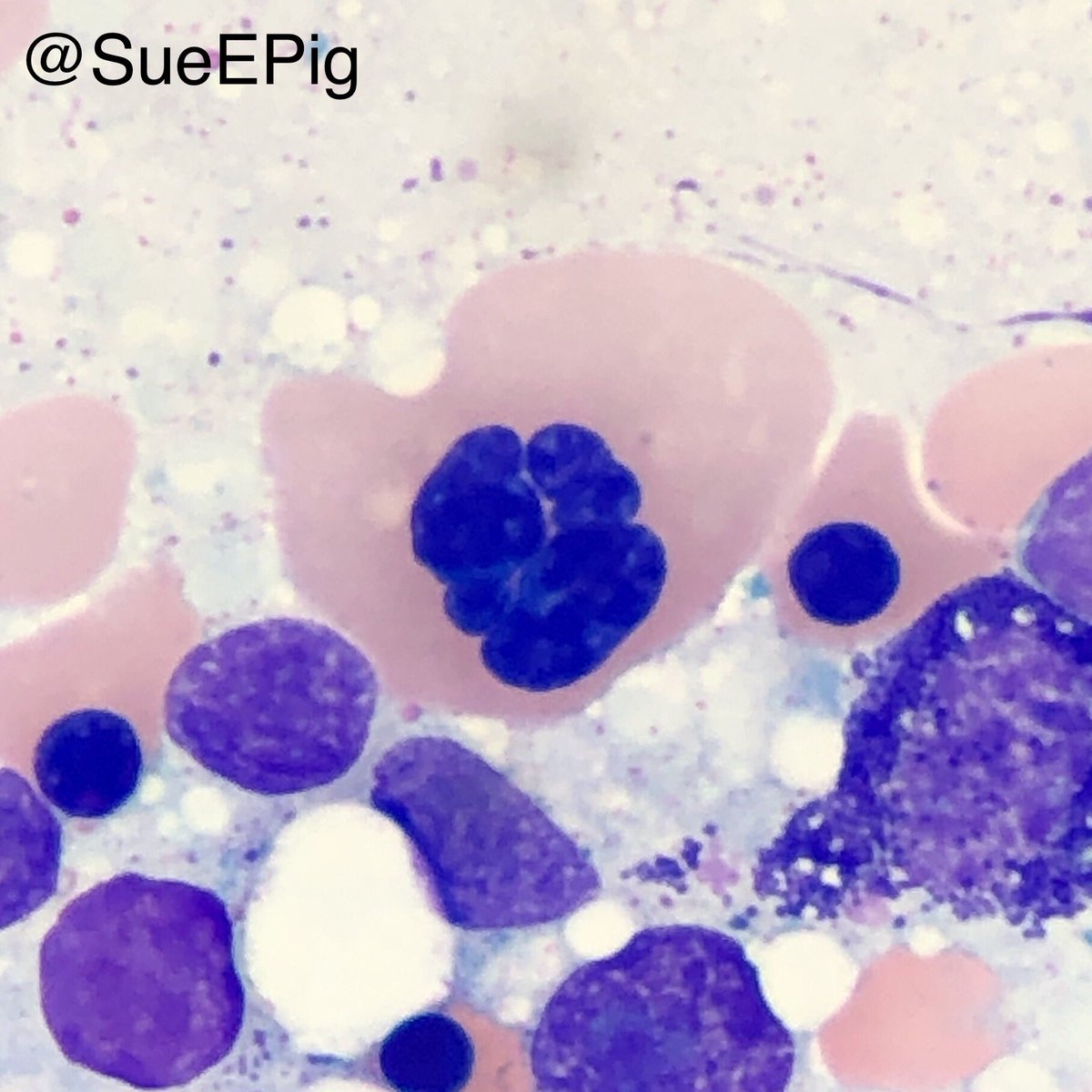 SueEPig's tweet photo. #dyserythropoiesis has been reported in assoc with immune-mediated disorders, drug toxicities, and myelofibrosis; may be a prominent feature of some hematopoietic neoplasms, especially erythroleukemia, and some myelodysplastic syndromes #hhpath #hemepath #bonemarrowaspirate https://t.co/vo9DGcsEX4