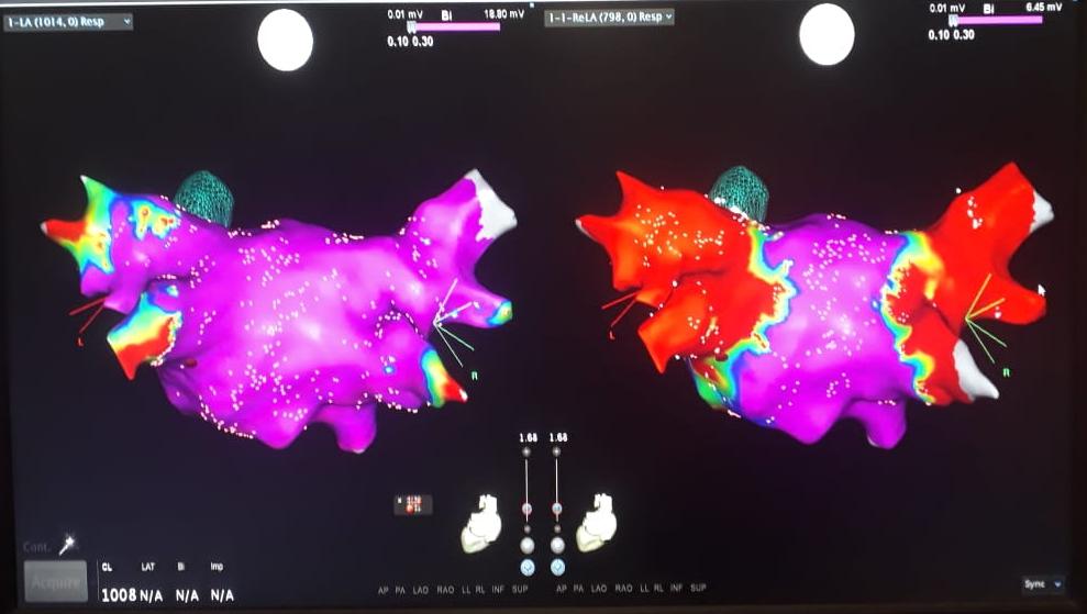 ALFIEEP1's tweet photo. First #PVI after #CircaDose
I love point by point RF using #Carto3 #Confidense
I know that beyond RCT #Epeeps have their own preferance.
Case done yesterday with @nlcabanillas
#InstitutoCardiovascularAdventista
#BiosenseWebster
What is your favorite ABL approach for #PAF ? https://t.co/5X3RhqHjHK