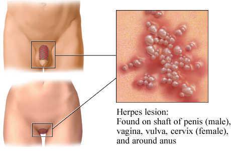  #HSV Herpes Simplex Virus HSV-1 Type 1 - cold soresHSV-2 Type 2 - genital herpesTransmitted via oral sex? YesIf you have ever had a cold sore, you have HSV Type 1Easy to treat. Mention that you get cold sores during your pre-sex chat