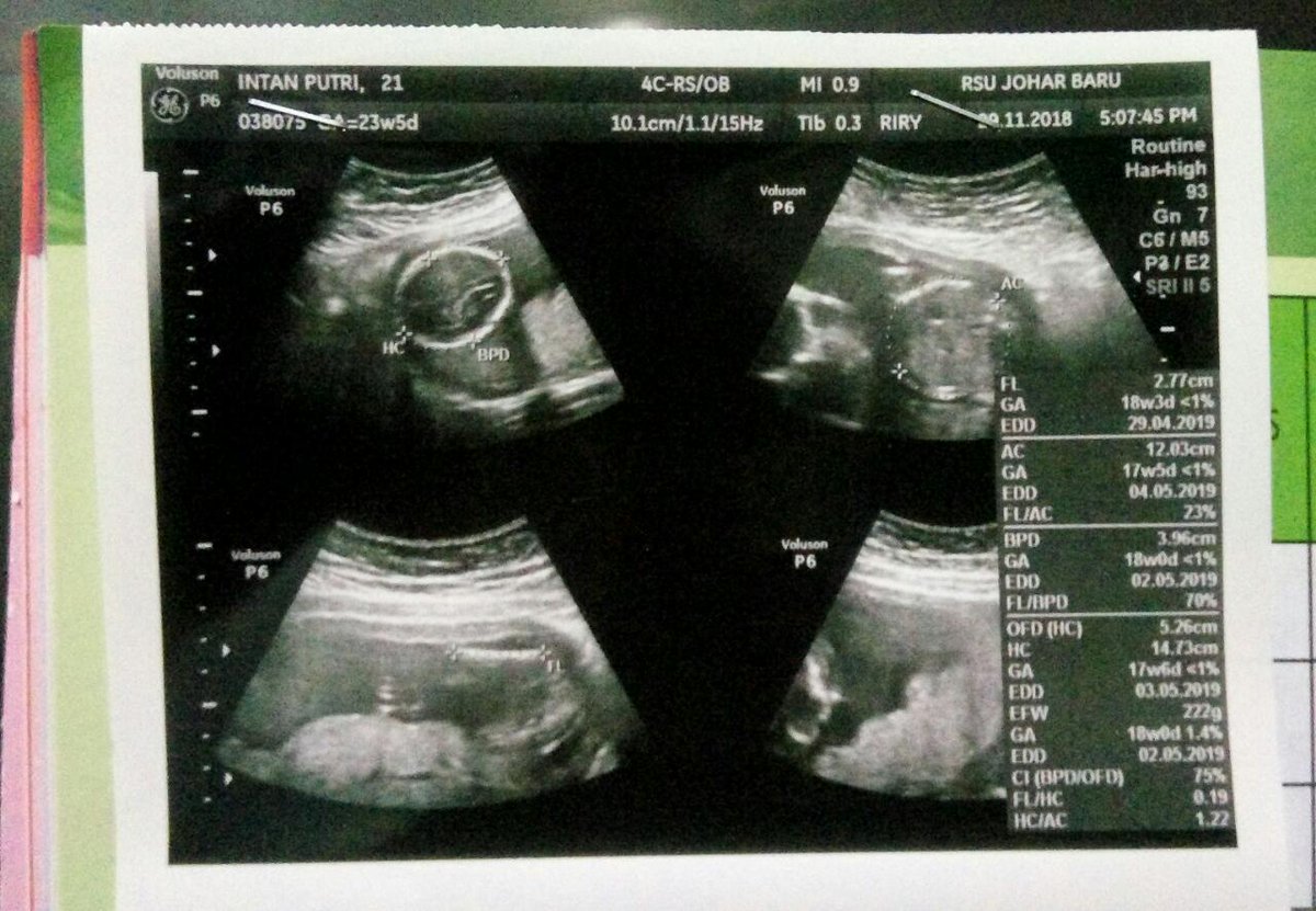 iputriutami_'s tweet photo. Ini hasil USG pertama, sikecil alhamdulillah sehat dan aktif💕 https://t.co/dVdAnsMhrU