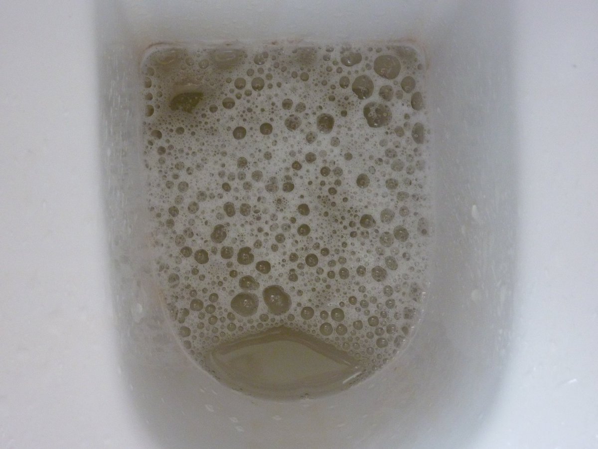 A Thread From Drolufunmilayo Hello If You Pee And Every Time You Finish Your Urine Looks Like This Picture You May Have A Serious