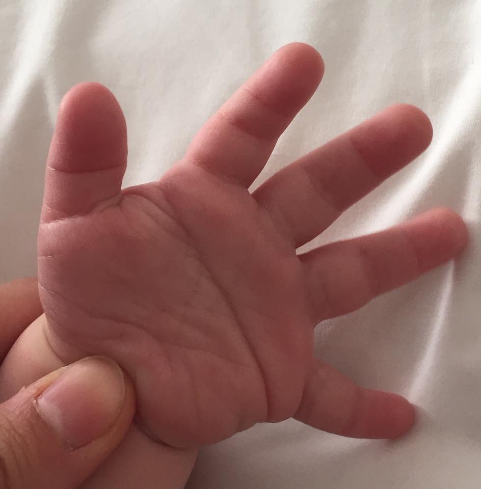 gecimanep's tweet photo. Pliegue palmar transversal único🤚🏼

Es más frecuente en hombres que en mujeres, pero se ve asociado en mayor frecuencia a la trisomía 21 o Síndrome Down, como en el caso de esta pequeña palma de una bebé con esta condición. 

🤲🏽21 de marzo, día mundial del Síndrome Down🧒🏻👦🏽 https://t.co/8kpFQyHYeN