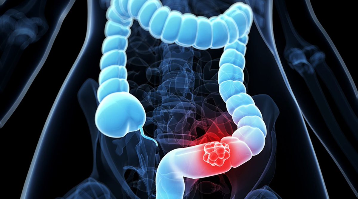 CCAlliance's tweet photo. "71 percent of patients below age 50 have stage 3 or 4 #ColorectalCancer" Thank you @TechTimes_News for sharing our research and spreading awareness w/ us during #ColorectalCancerAwarenessMonth https://t.co/Y4OJKIrmxI https://t.co/WPXAvsJ0jf