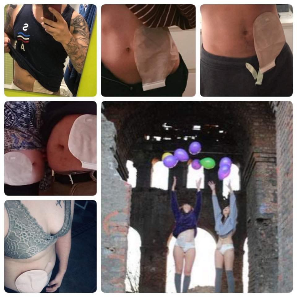 ACCU_Espana's tweet photo. El reto #24horasconbolsa que pusieron en marcha Raquel (@raquelccid) y Arantxa (@arantxamc7) ha dejado imágenes de personas que por un día se pusieron en la piel de un paciente ostomizado.
Olé por toda esta gente que lucha, comprende y se implica #ostomía. https://t.co/dK7S3WCYQ8