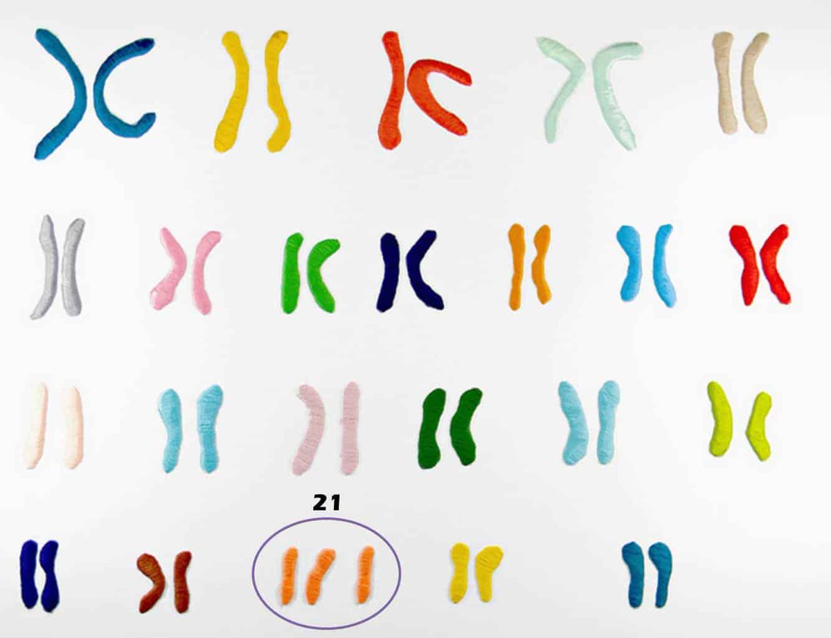 File:Burkitt's lymphoma illustration-es.png - Wikimedia Commons, image size:1200x922