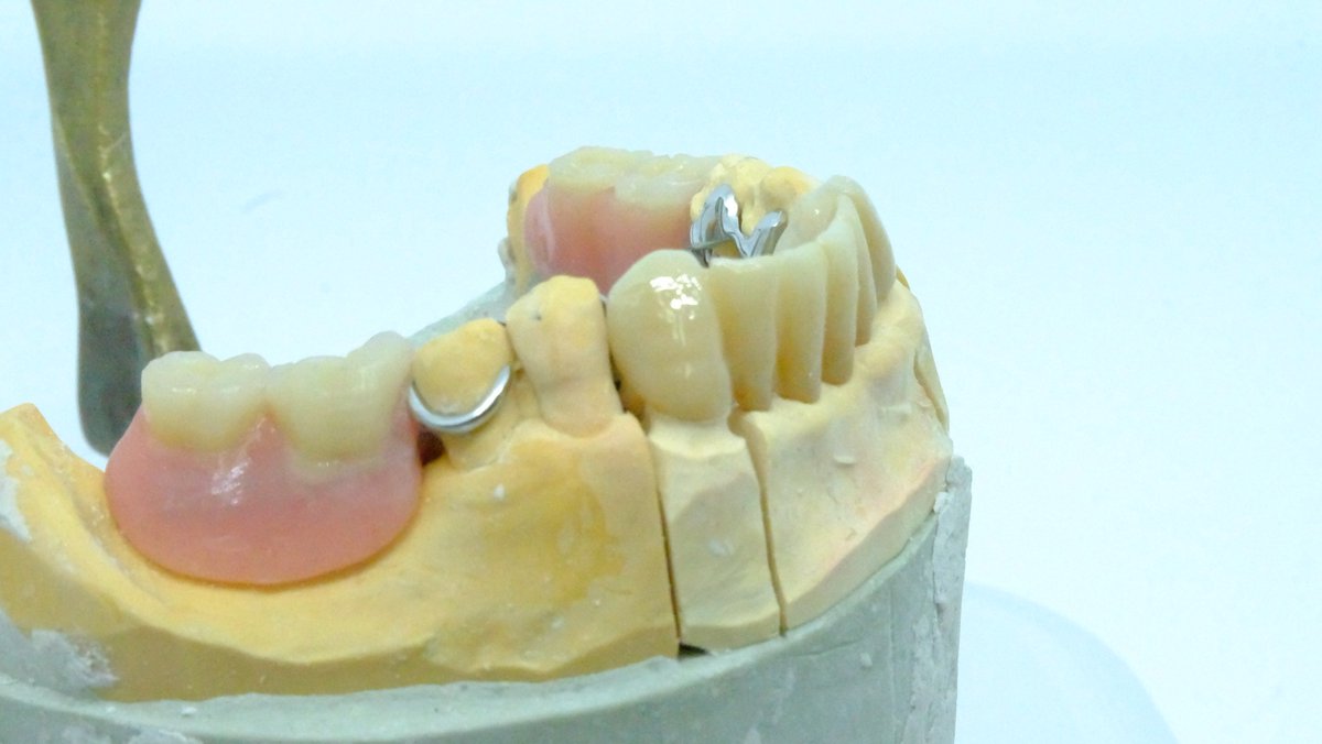 jpdentallab's tweet photo. #LaboratorioDental 🤔 ¿Sabéis para que sirve un esquelético con cuerpo metálico? Las #ClinicaDental 🦷 nos lo encargan cuando sus pacientes no ven con claridad un tratamiento altamente invasivo prefiriendo otras opciones viables #BadalonaDental Descubre 👉 https://t.co/Q6U57pUr30 https://t.co/n2wZ6fev2K