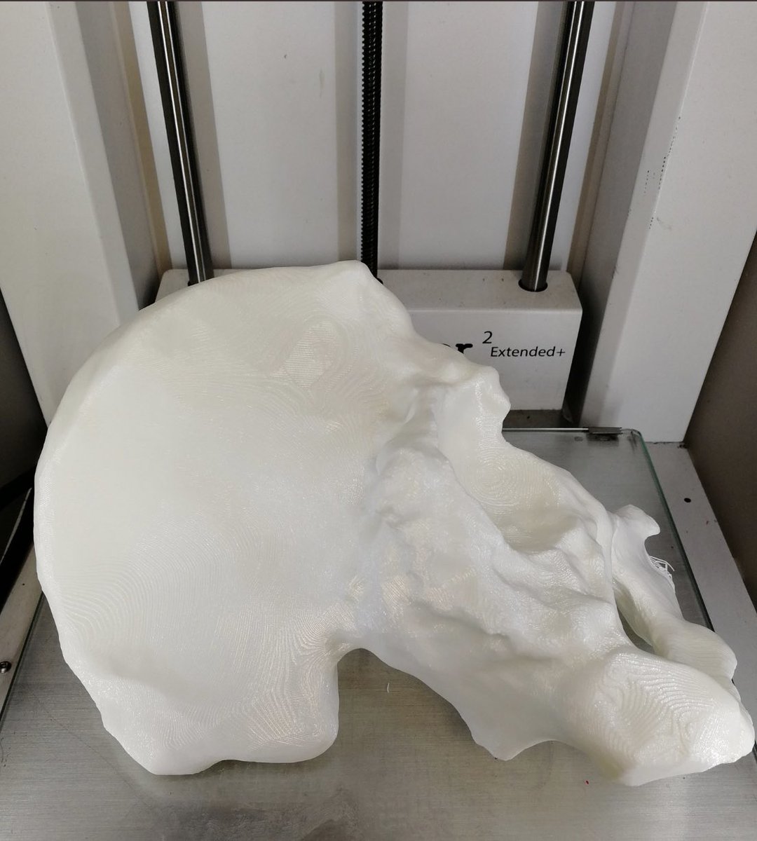 psanzruiz's tweet photo. @sandrasv97 @3d_maranon @rupermac @calvoharo_ja @diegotrap @kn_ord Infected hip resection for 12 years. 9cm right limb 9 cm shorter. Two stage with mobile hand made spacer in the first stage and trabecular metal cup plus MP stem. Just teo cm shorter after surgery. Fantastic 3d preOP planning! Its really make my work easier. https://t.co/DTZpMi7ktK