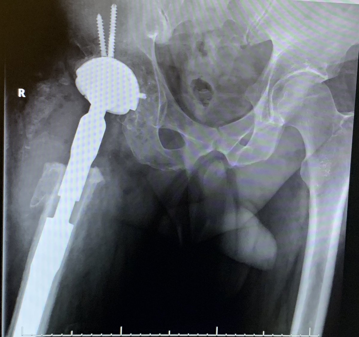 psanzruiz's tweet photo. @sandrasv97 @3d_maranon @rupermac @calvoharo_ja @diegotrap @kn_ord Infected hip resection for 12 years. 9cm right limb 9 cm shorter. Two stage with mobile hand made spacer in the first stage and trabecular metal cup plus MP stem. Just teo cm shorter after surgery. Fantastic 3d preOP planning! Its really make my work easier. https://t.co/DTZpMi7ktK