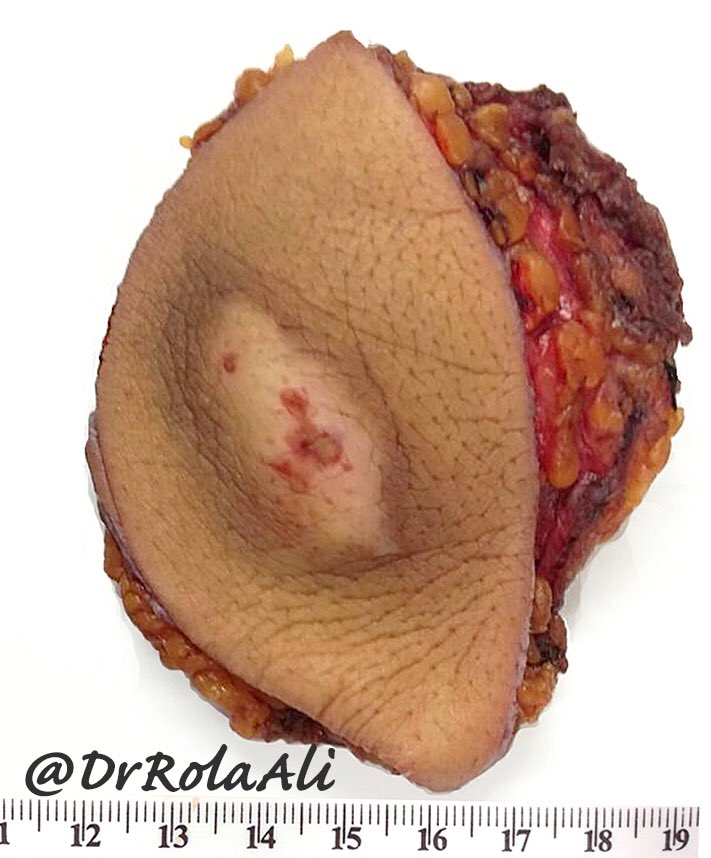 DrRolaAli's tweet photo. This is a classic example of what it is! I donβt think Iβm gonna see it again any time soon! 49/M paraplegic, thoracic wall mass, more will follow #BSTPath #MSKPath #GrossPath #pathology @LizMontgomeryMD @AltaherN88 @Dr_Sara_Alsaad @ya3gooban @NPathRes @DrGeeONE @nusrat_xahra https://t.co/mliu3PK0YK