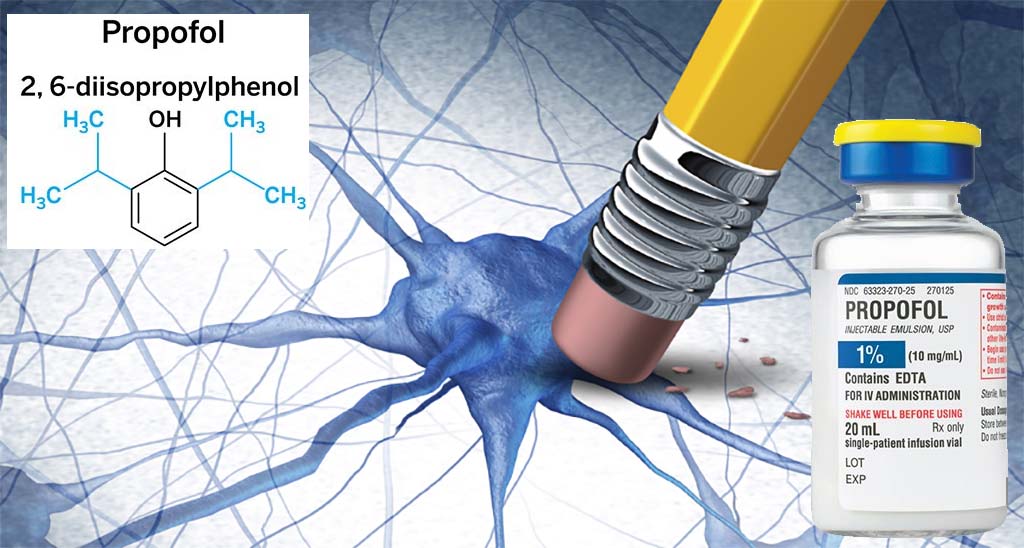 debugliesnews's tweet image. #Propofol can #muddle #memories of specific incidents debuglies.com/2019/03/21/pro… di @debugliesnews