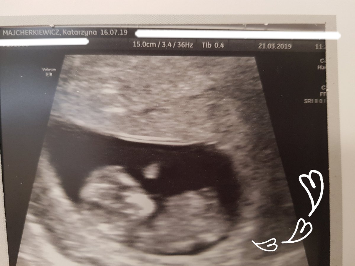 LiveSzczerba's tweet photo. I just saw my baby for the first time ❤️❤️❤️❤️😍😍😍 A feeling that words can't describe 😍😍😍😍😍😍 I'm the happiest man on the planet atm 😊😊

#happy
#fathertobe
#babyscan
#happiestmanonearth https://t.co/TcIEXyKETE