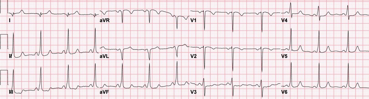 Here's a great #ECG of a young lady who presented to the ER with episodes of chest pain, dizziness, and feeling a "black cloud coming over my vision."  

What's the diagnosis?
