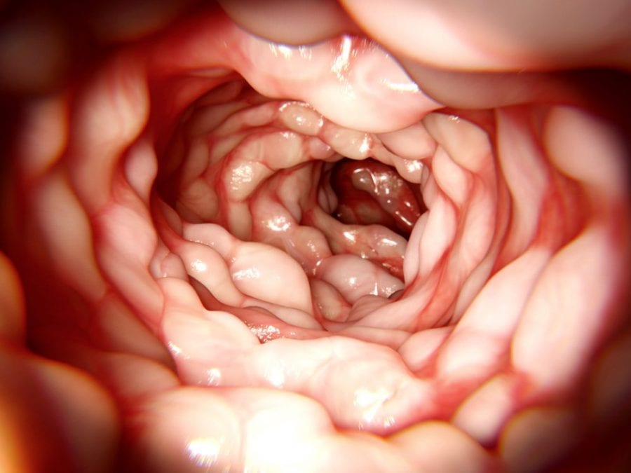 RxLeafMD's tweet photo. 19-year old Patient X had to choose to die from her severe Crohn's or become a 'medical refugee'. https://t.co/OD0JTu5jIC #crohnsdisease #cannabisworks #medicalcannabis #inflammation #rxleafmd https://t.co/4M7yOIFS5h