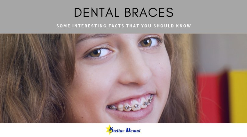 Braces straighten your teeth and relocate them to a spot that is suitable for a healthy mouth. There are many exciting facts on dental braces. Read more. stellardentalllc.com/blog/dental-br… #dentalbraces