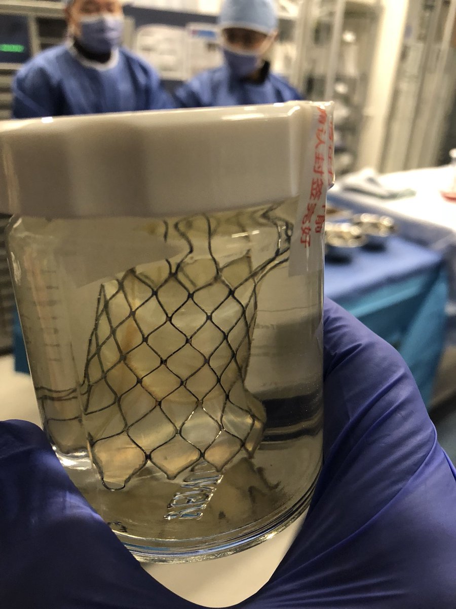 Great day joining <a href="/RiahiDr/">Dr Mounir Riahi</a> for Venus valve implants today #UBC

This valve has the potential to allow many more of our #CHD patients to have catheter based treatment instead of surgery
<a href="/SCAI/">SCAI</a> #pedscards #CardioTwitter
