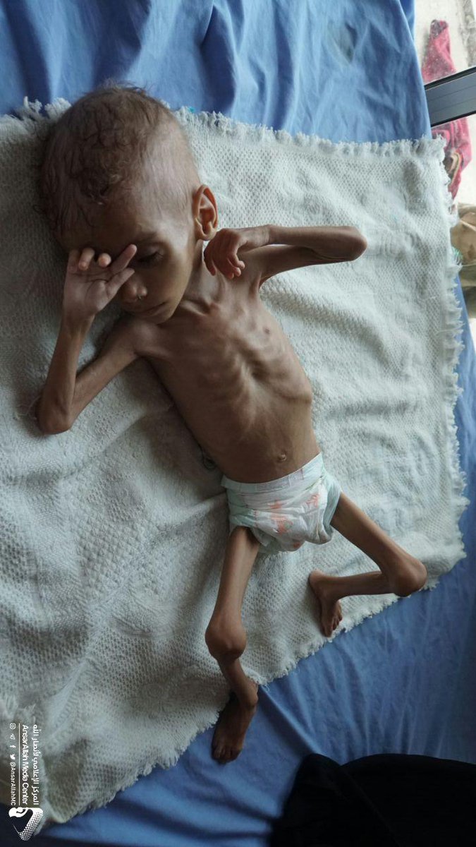 FdAERM5o7KxGusN's tweet photo. The ghost of famine is hunting around 20 million #Yemenis under the US-Saudi blockade - Aslam area in Hajjah province north of #Yemen is just an example of the magnitude tragedy #4YearsOfUSWarOnYemen https://t.co/a7cvg4JA1l