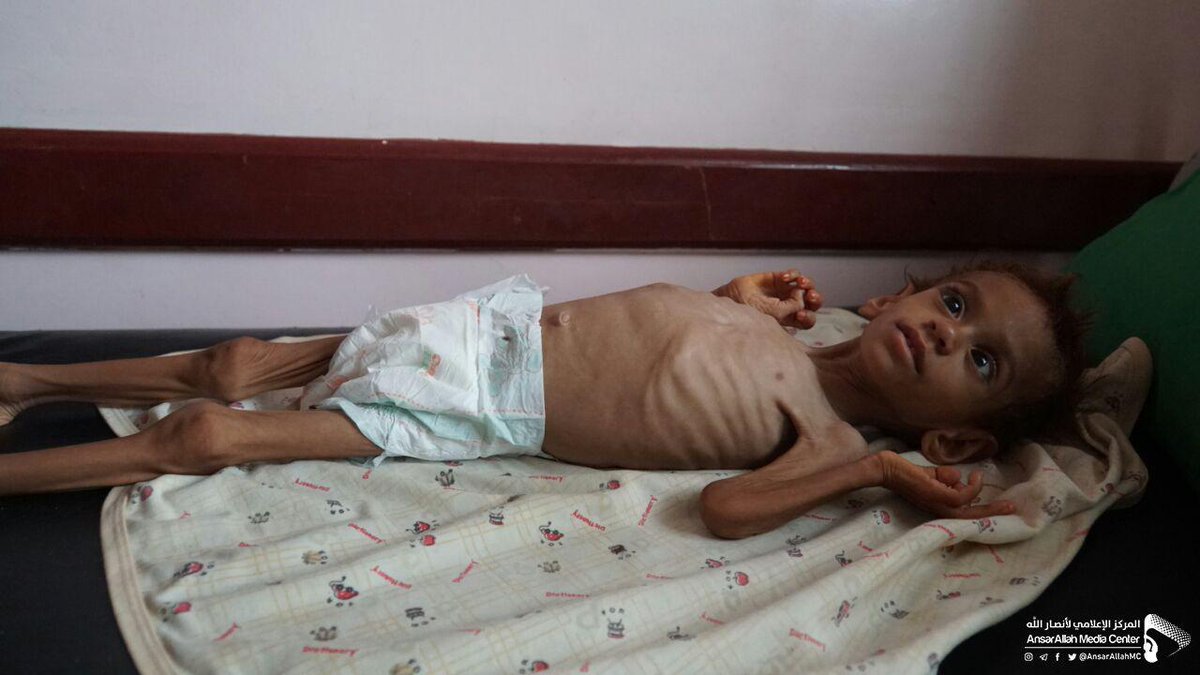 FdAERM5o7KxGusN's tweet photo. The ghost of famine is hunting around 20 million #Yemenis under the US-Saudi blockade - Aslam area in Hajjah province north of #Yemen is just an example of the magnitude tragedy #4YearsOfUSWarOnYemen https://t.co/a7cvg4JA1l