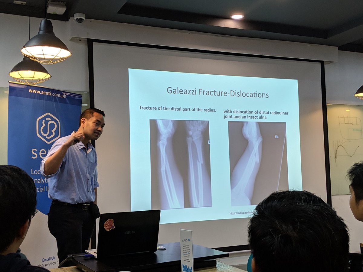ralphjregalado's tweet photo. #TFDevSummit #ExtendedManila Dr. Erwin, a radiologist at UP PGH, shares how he was able to self-taught building #machinelearning models to classify Monteggia and Galeazzi fractures using #TensorFlowJS @TensorFlow https://t.co/bwC8uSnr5i