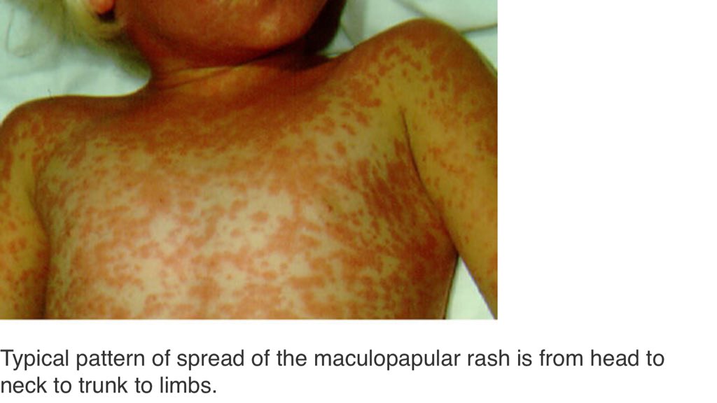 Juli0BS's tweet photo. #ENARM

〽️Exantematicas

🔰Sarampión [Measles]
⚠️Familia: Paramyxoviridae
⚠️Género: Morbillivirus

✅Incubación: 7-18d

✅Rash que inicia típicamente en cabeza y se extiende de forma descendente

🔥Manchas de Koplik [Enantema]
A la altura de 2° molar superior
#DrPool https://t.co/ehbff30NR0