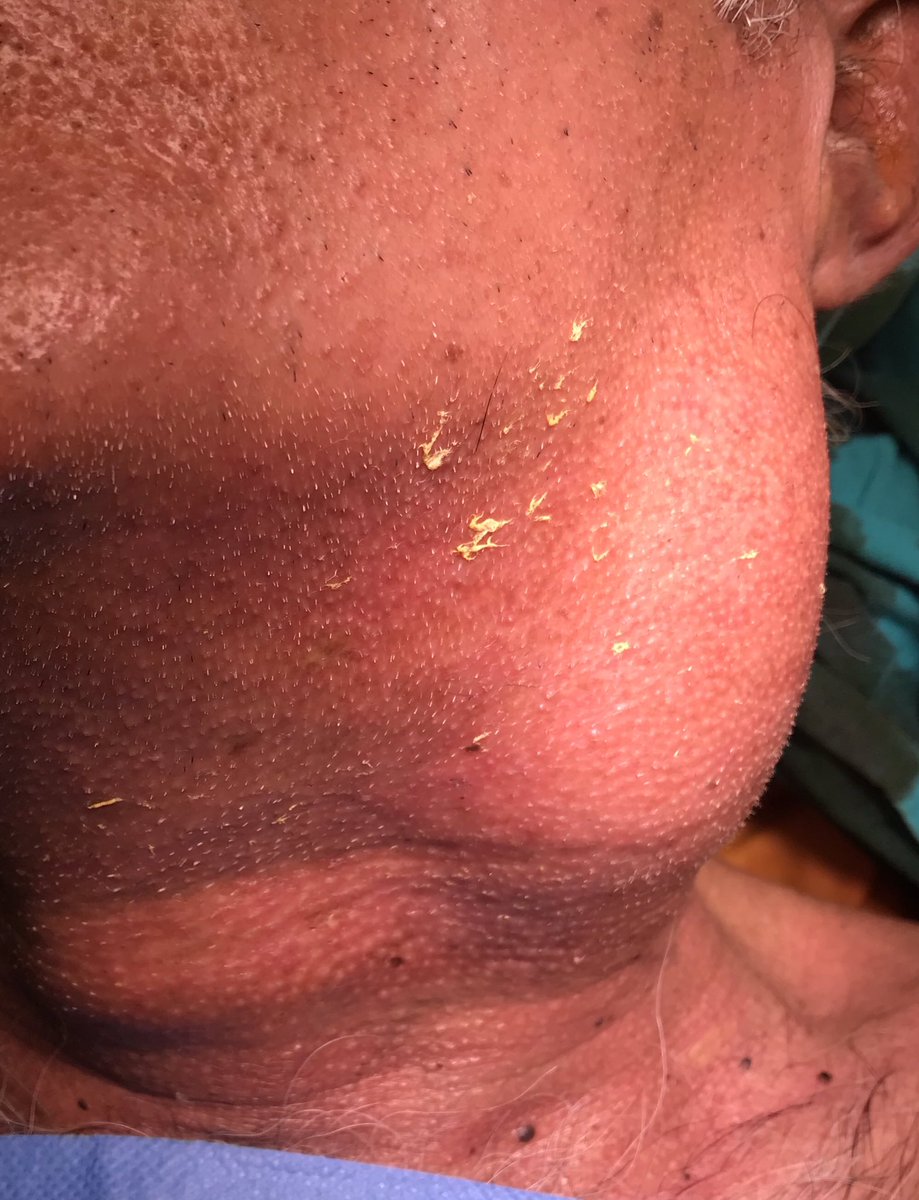 DrJMughal's tweet photo. 69yr old with severe neck stiffness & huge cancer in neck from Gutka!
Can follow step by step on #snapchat @DrJMughal
#NOTOGUTKA
#surgicalchallenges https://t.co/uKxgpDYkgT