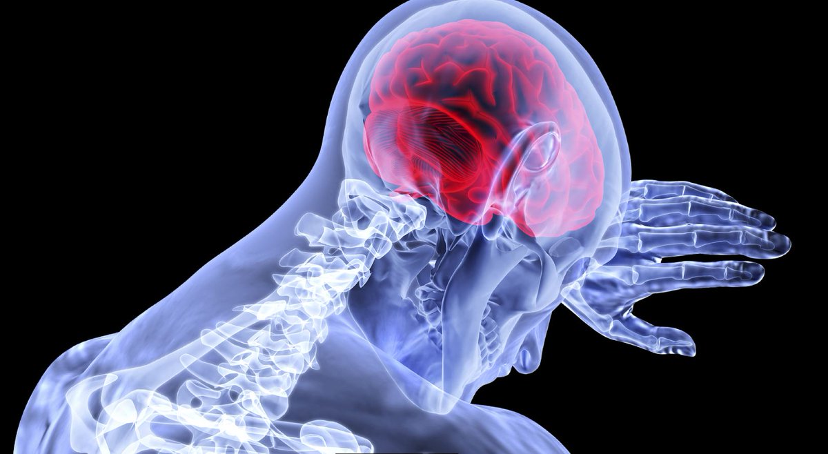 news_ub's tweet image. Dr Alex Sinclair (@IIHDrBirmingham) and her team has found excess hormones could cause Idiopathic Intracranial Hypertension #IIH - a condition that can lead to blindness @IIHUK Read more: birmingham.ac.uk/news/latest/20…