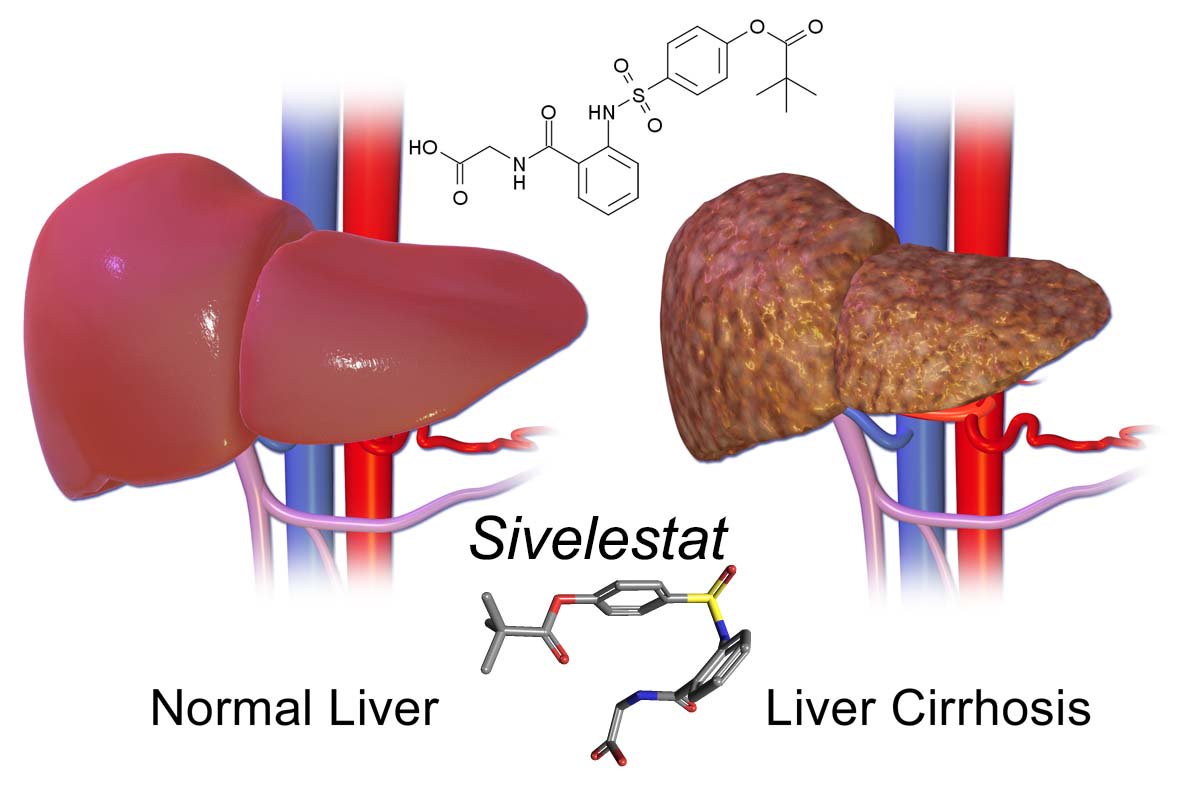 The drug #Sivelestat may lower portal hypertension in patients with #chronic #liver #disease debuglies.com/2019/03/22/the… di @debugliesnews