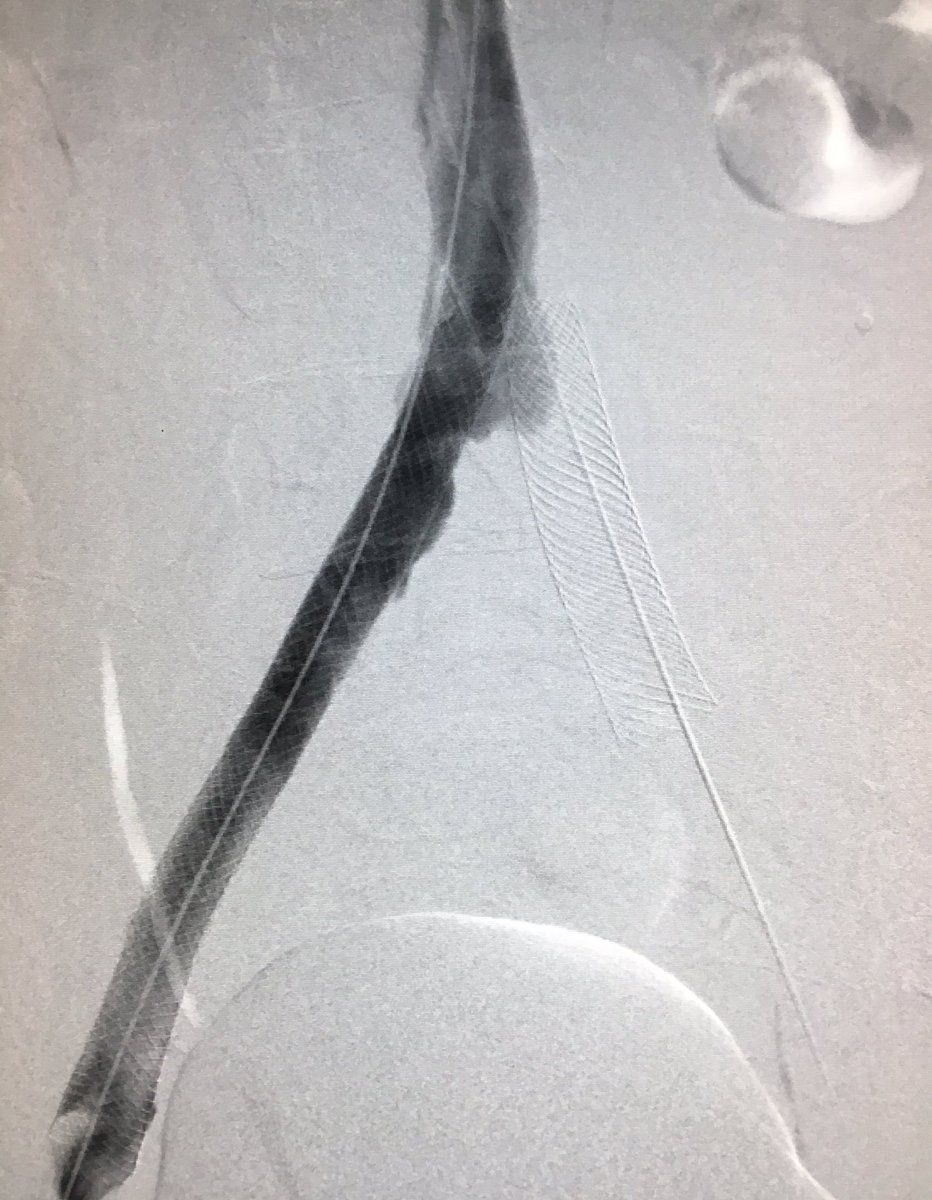 50F s/p distal pancreatectomy for NE tumor 2 wks ago at OSH developed severe LLE pain/swelling 6 days ago.  DVT from common iliac to popliteal. #ClotTriever removed nearly all of the clot and exposed underlying May Thurner and a second area of common iliac vein stenosis.