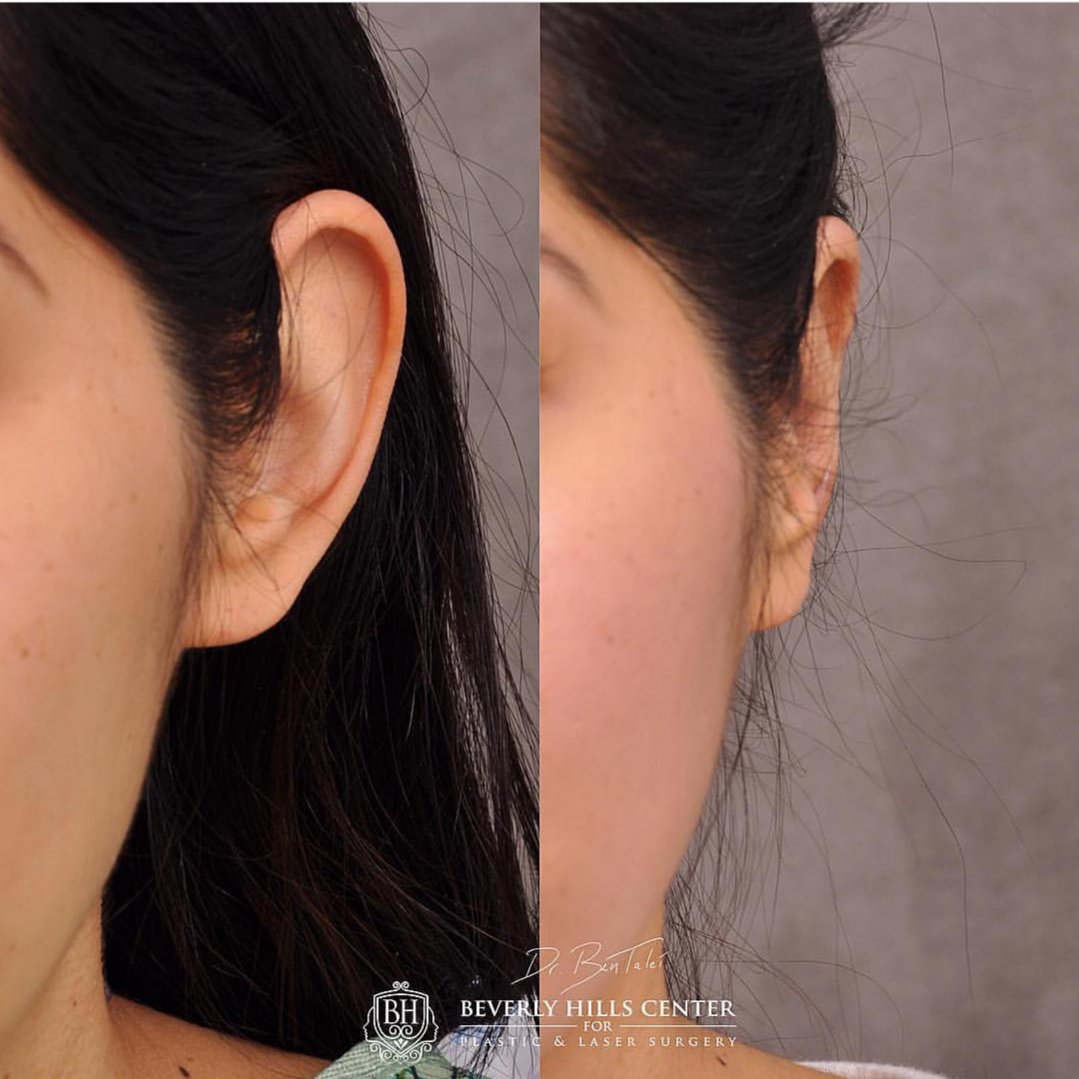 DrBenTalei's tweet photo. This patient is one month out from 𝗢𝘁𝗼𝗽𝗹𝗮𝘀𝘁𝘆/𝗘𝗮𝗿 𝗥𝗲𝘀𝗵𝗮𝗽𝗶𝗻𝗴...a very quick, yet complex and artistic procedure. She's thrilled with her results!
#otoplasty #earreshaping #earlobereconstruction https://t.co/CCOWyKwUrS