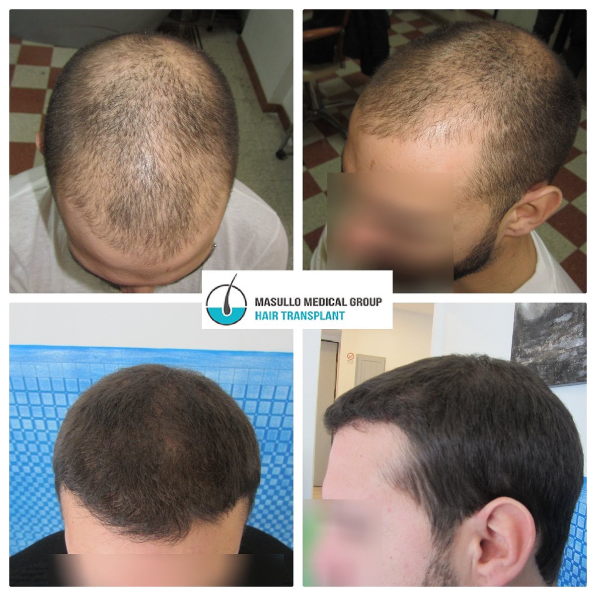 hairtra_masullo's tweet photo. 2520 #grafts #fuetransplant 11 months later. #hairtransplantation is the only #hairrestoration solution offering permanent results. #fuemethod surpassed what medications and #hairlosstreatments alone can do to treat #hairlossproblems➡️🌐#masullomedicalgroup #trichology #baldness https://t.co/gtIf8xwItR