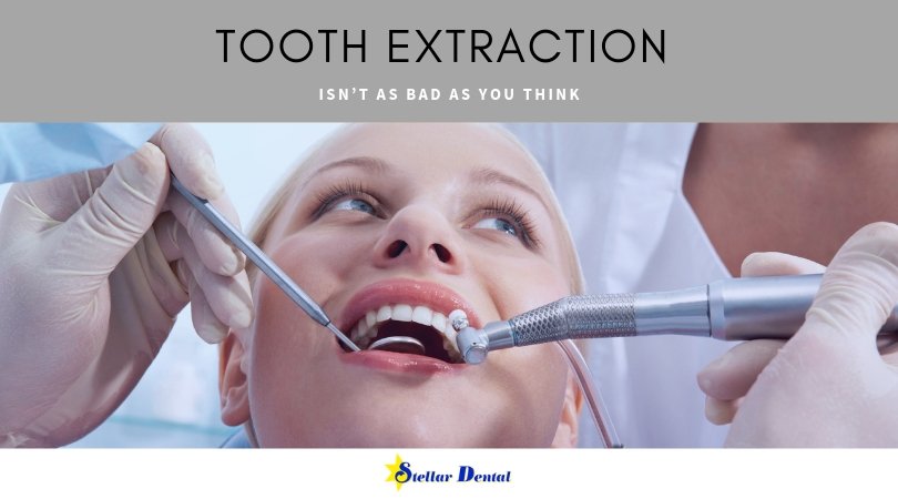 Tooth extraction is the removal of a tooth or teeth through a sequence of procedures. Here are some important things you should know before completely shunning the idea of a tooth extraction. stellardentalllc.com/blog/tooth-ext… #toothextraction