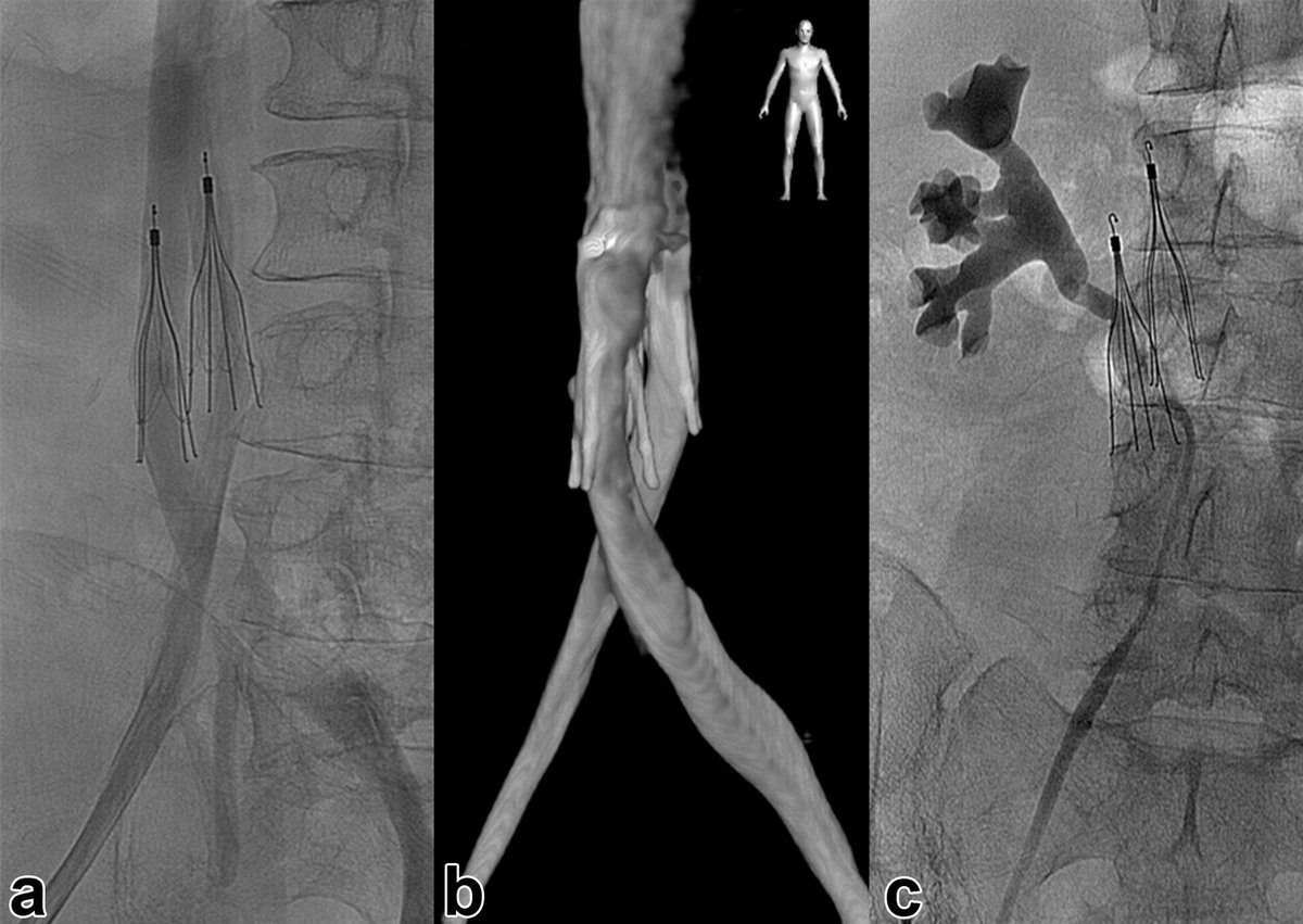 An anatomical oddity just in time for #IRad #FilterOut Friday authors.elsevier.com/c/1YmNU3k~jJF85~