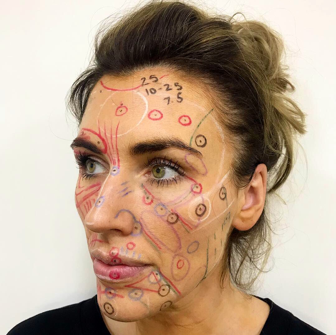 RajAcquilla's tweet photo. Precise assessment ๐ planning ๐ and exquisite results ๐๐ฝ๐ฏ from my live @Allergan #Botox #JuvedermUK #Masterclass today in #Manchester #UK ๐ฌ๐ง๐๐ฅ my next tour dates are #Peru for #WCOCD #Lima 29/3 โ๏ธ๐ต๐ช then to @euromedicom #AMWC #Monaco 4/4 โ๏ธ๐ฒ๐จ https://t.co/U82Ly0zsby