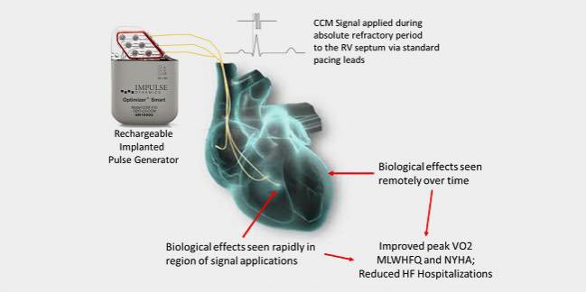 hannahcardio's tweet photo. New FDA-approved device for HF patients who are ineligible or CRT. The Optimizer Smart Implantable Pulse Generator delivers electrical pulses to RV septum during absolute refractory period following heart contraction #BIOM4180 https://t.co/ZVDT4oBhHk