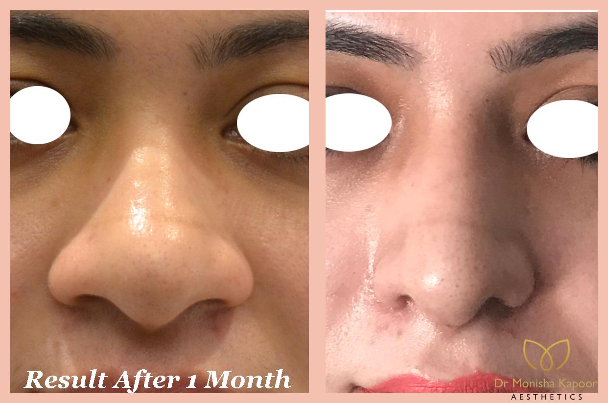 Normal nose on sale
