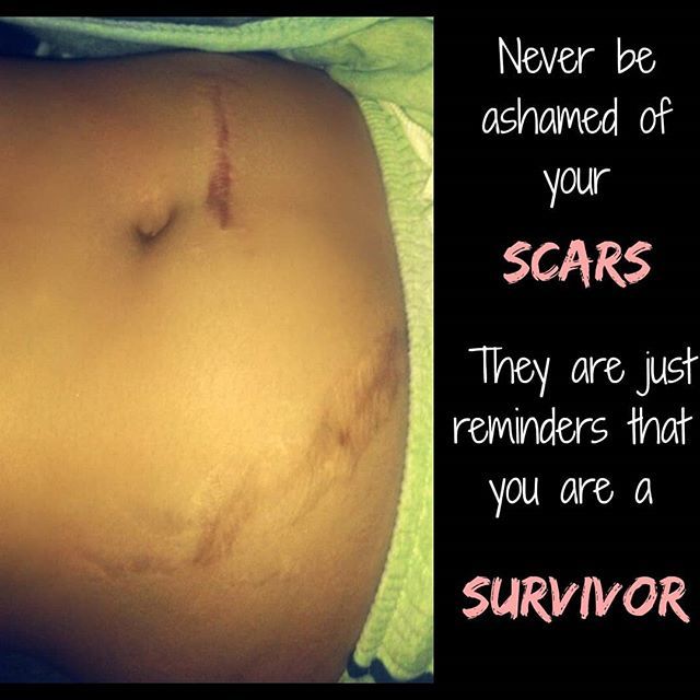 gee86's tweet photo. Always proud of my scars. Forever grateful 🙏

I can't even count how many hospital stays, surgeries and infections I've had over the years but one thing's for certain - I AM ALIVE.
🙌💪
.
.
.
.
.
.
.
#chronicillnesswarrior #kidneytransplant #ckd #scars… https://t.co/UiJLc6LE8J https://t.co/lZDkBC3z29