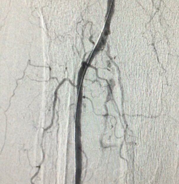 ErsaTatl's tweet image. Critical limb ischemia and percutaneous treatment : ipsilateral antegrade approach; Armed microcatheter and gladius 0,14 wire and deb balloons were used. #cto #eurocto #ipsilateral #peripheric #artery #disease #RadialFirst #sakarya #woundcare #Diabetics #foot