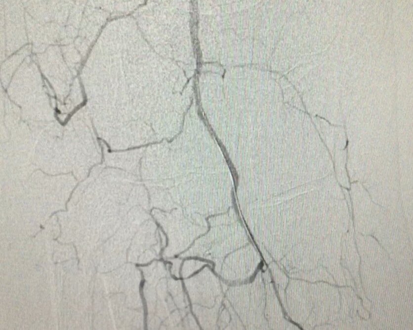 ErsaTatl's tweet image. Critical limb ischemia and percutaneous treatment : ipsilateral antegrade approach; Armed microcatheter and gladius 0,14 wire and deb balloons were used. #cto #eurocto #ipsilateral #peripheric #artery #disease #RadialFirst #sakarya #woundcare #Diabetics #foot