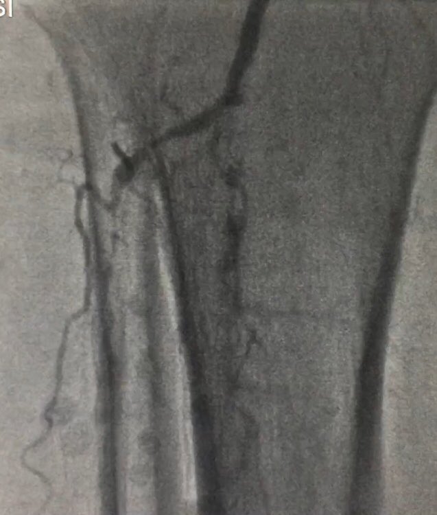 ErsaTatl's tweet image. Critical limb ischemia and percutaneous treatment : ipsilateral antegrade approach; Armed microcatheter and gladius 0,14 wire and deb balloons were used. #cto #eurocto #ipsilateral #peripheric #artery #disease #RadialFirst #sakarya #woundcare #Diabetics #foot
