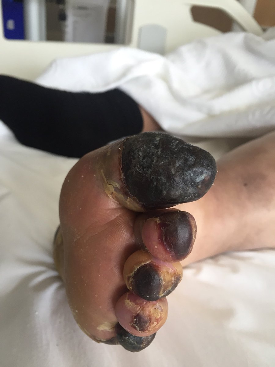 ErsaTatl's tweet image. Critical limb ischemia and percutaneous treatment : ipsilateral antegrade approach; Armed microcatheter and gladius 0,14 wire and deb balloons were used. #cto #eurocto #ipsilateral #peripheric #artery #disease #RadialFirst #sakarya #woundcare #Diabetics #foot