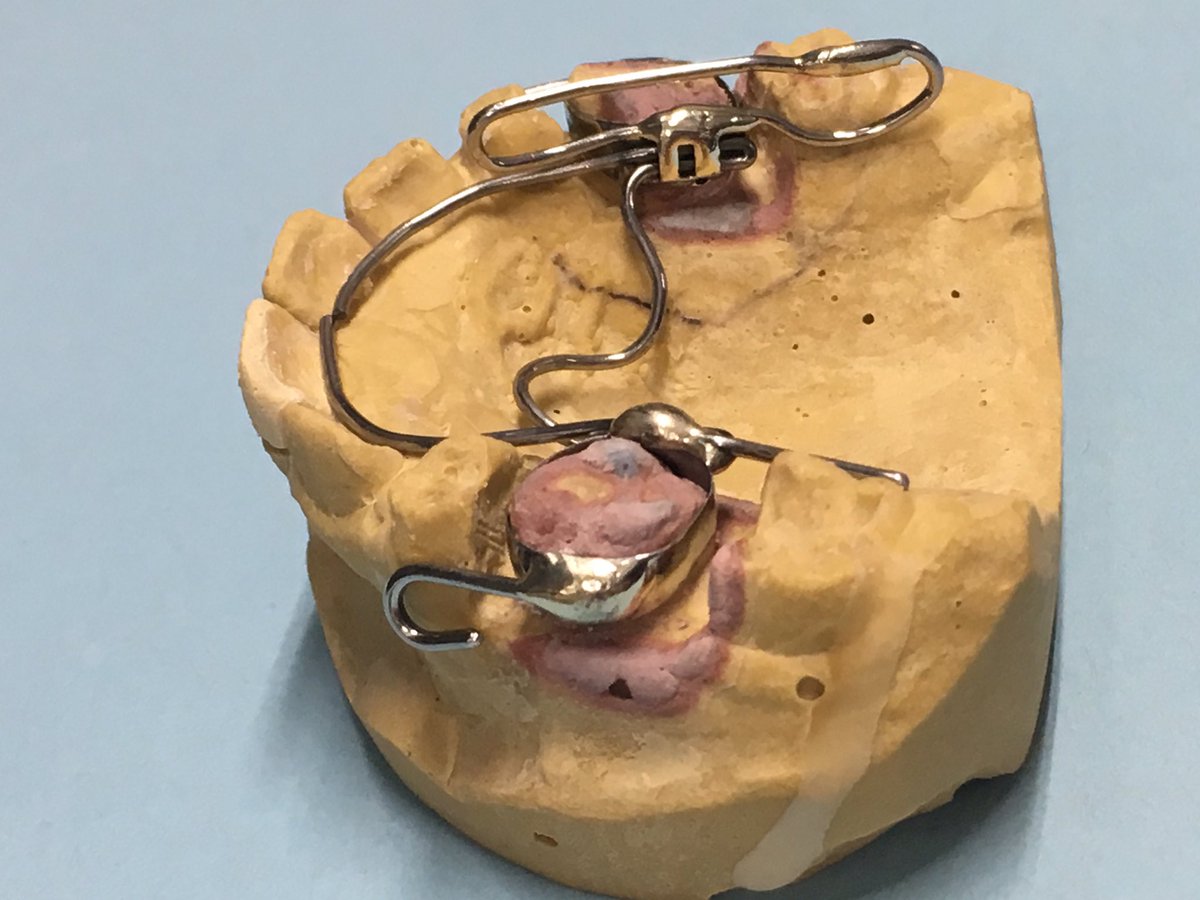 OrthoLabVideos's tweet photo. New Video:  Titanium expanders for identical twins with Nord addition for unilateral cross bite correction. https://t.co/brJj312kMT   #orthodontist #orthodontic #orthodontics #pediatricdentistry #pedodontics #orthodontictechnology
#orthodonticassistant  #dentalassistant #braces https://t.co/jB72s6RcPM