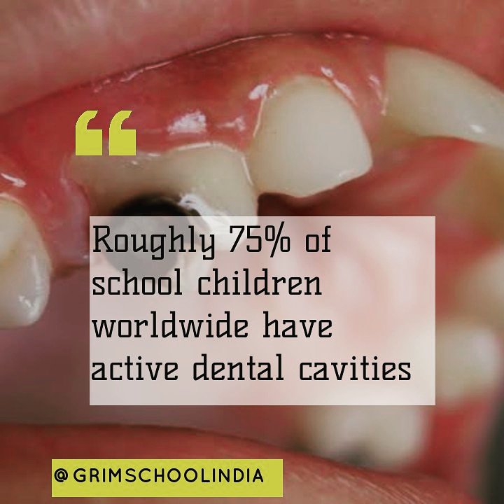 GRIMSCHOOLIND's tweet photo. One of the major fix which is commonly seen in the students while their school days. 
#cavity #school #teeth #stop_cavity #grim_school_india #GrimCover #GrimHandWash #dentalhygienist #dental @GRIMSCHOOLIND @dentaladvisor https://t.co/tSN8yqBtuU