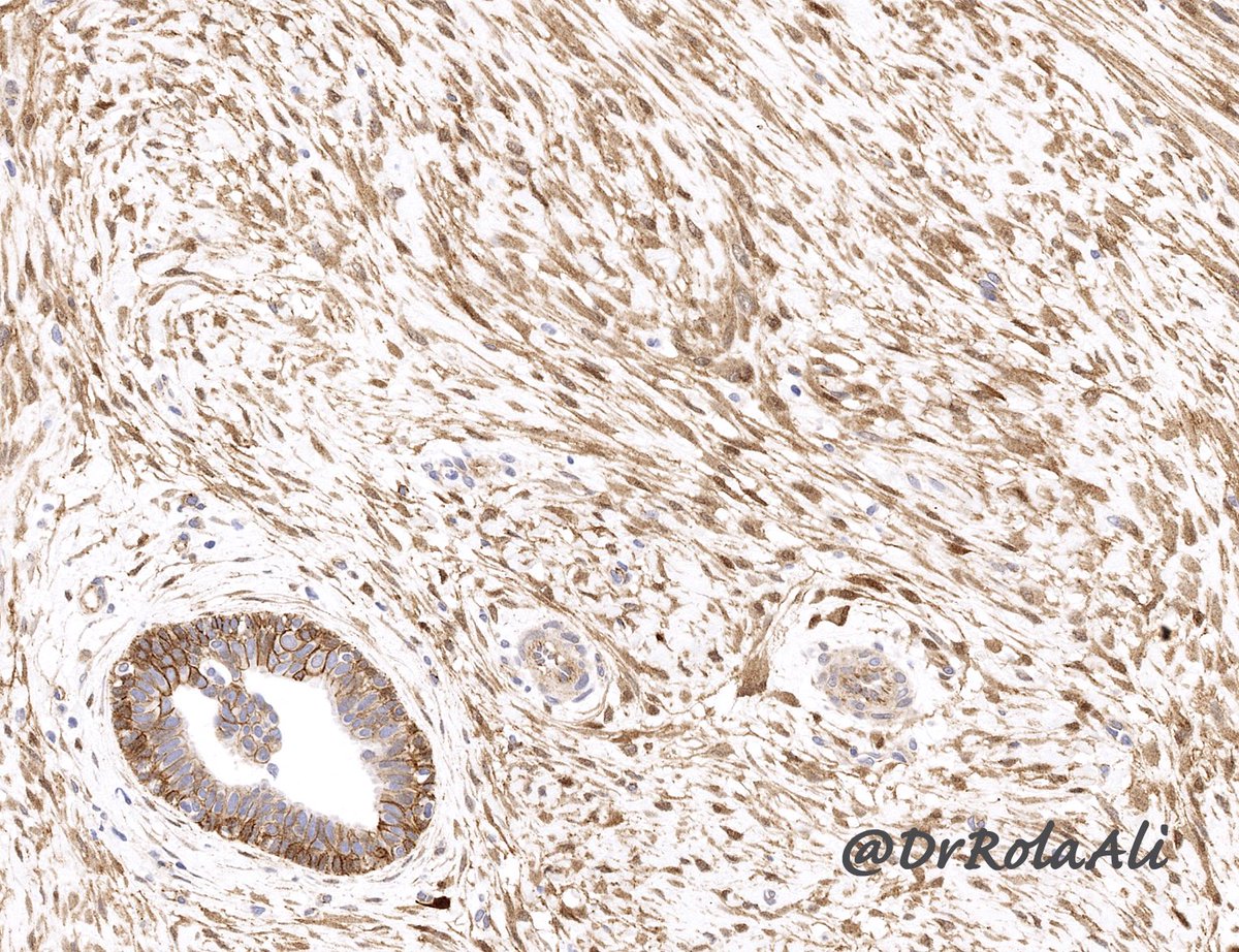 DrRolaAli's tweet photo. For the sake of completion, here is the beta-cat. Nice contrast between nuclear staining in fibromatosis and normal membranous expression in adjacent breast duct cells. #PathTweetAwards #humanpathology @LizaMQuintana @pembeoltulu @jennpincus @DrGeeONE @nusrat_xahra #BreastPath https://t.co/lQ2LAKcCO5