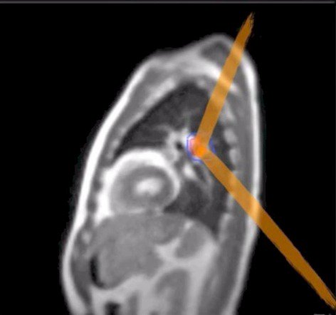 viewray's tweet photo. #Radoncs: Curious to know about the application of MR image-guided RT to lung cancer? Attend the Lung SABR / SBRT Workshop @the_RSS: March 23, 2:30 – 4:30 pm, Nautilus Rooms 1-3. Learn more: https://t.co/EwFZOXObbg  #theRSS2019 #PrecisionMedicine #MRIdian https://t.co/N0c3sBykY1