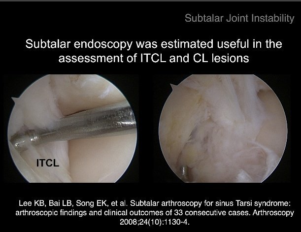 grecmip's tweet photo. Dr Vila y Rico has explained us how Subtalar Endoscopy can be useful in the assessment of the Interosseous Talocalcaneal Ligament (ITCL). #grecmipcongress2019 #ankle #arthroscopy #subtalar #instability @vilayrico https://t.co/lpeBETiHDp