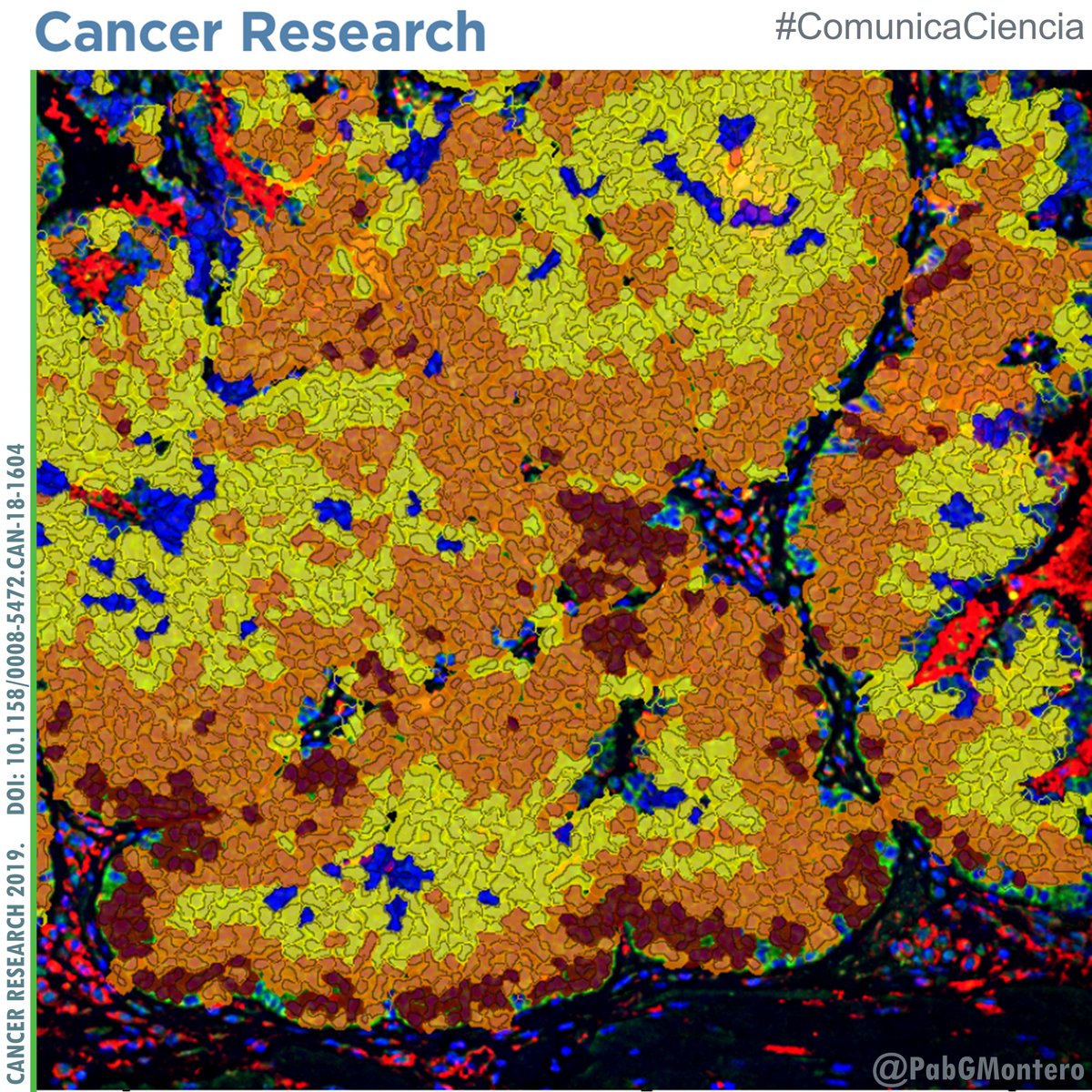 PabGMontero's tweet photo. El ambiente #ácido desencadena expresión de #genes que ayudan a las células cancerosas a moverse y promover la #metástasis.

El estudio, publicado en @AACR, contiene también un tratamiento efectivo en ratones reduciendo la acidez.

👉@MIT https://t.co/f3r3PFf1ez

#ComunicaCiencia https://t.co/uJaKjvWgiO