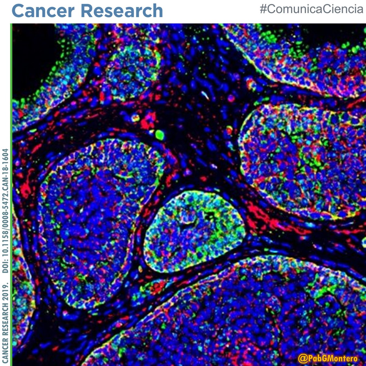 PabGMontero's tweet photo. El ambiente #ácido desencadena expresión de #genes que ayudan a las células cancerosas a moverse y promover la #metástasis.

El estudio, publicado en @AACR, contiene también un tratamiento efectivo en ratones reduciendo la acidez.

👉@MIT https://t.co/f3r3PFf1ez

#ComunicaCiencia https://t.co/uJaKjvWgiO