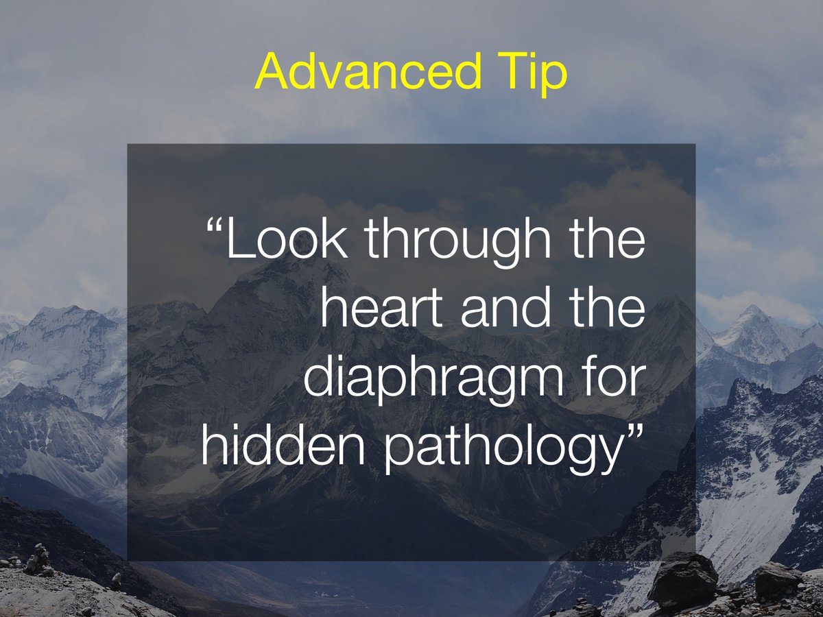 drcraighacking's tweet photo. Great tip from @DrAndrewDixon at @Radiopaedia #EmergencyRa. Find that subtle lower lobe consolidation, look for loss of pulm vessels behind the hemidiaphragm. https://t.co/qxMJEYBxhQ
