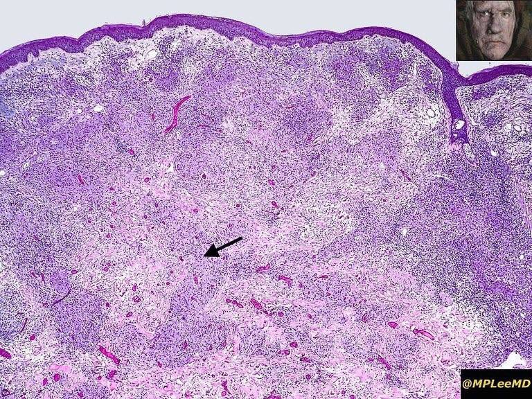 MPLEEMD's tweet image. Lepromatous leprosy. Mycobacterium Leprae infection in immune compromised. Granulatomous inflammation packed with organisms; +/-perineural inv. Nerve dmg --&amp;gt; can't feel that I just stepped on a nail -&amp;gt; infection --&amp;gt;deformity. Armadillo carrier.  #dermatology #dermpath #patholo